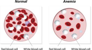 anemija