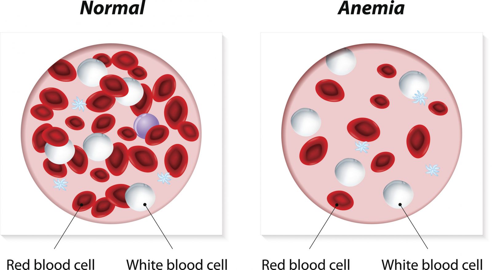 ANEMIJA - TOP 5 NAMIRNICA ZA LECENJE ANEMIJE ! - NUTRICIONISTA