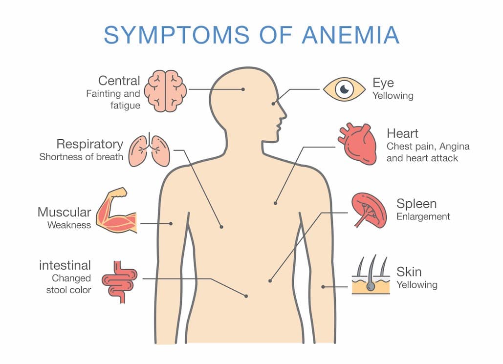 Anemija top 5 namirnica za lecenje anemije nutricionista